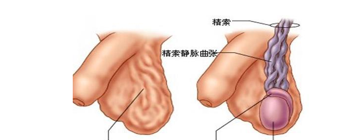 精索静脉曲张更容易发生在左侧蛋蛋吗 左侧精索静脉曲张会引发右侧精索静脉曲张吗