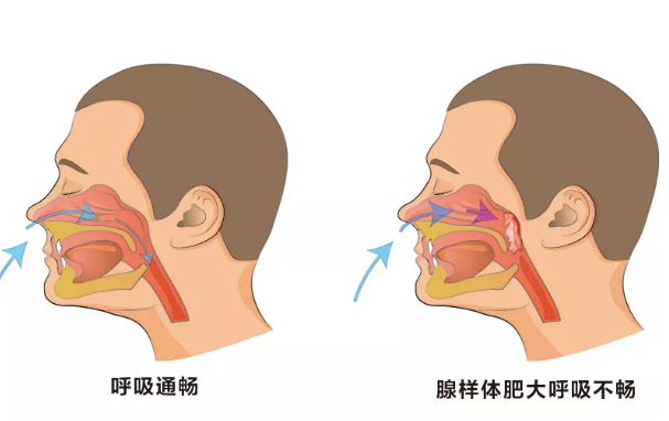 宝宝腺样体肥大怎么办 腺样体肥大能治好吗