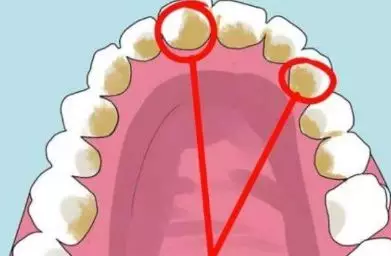 牙齿一刷就流血怎么办 为什么会出现牙龈出血的情况
