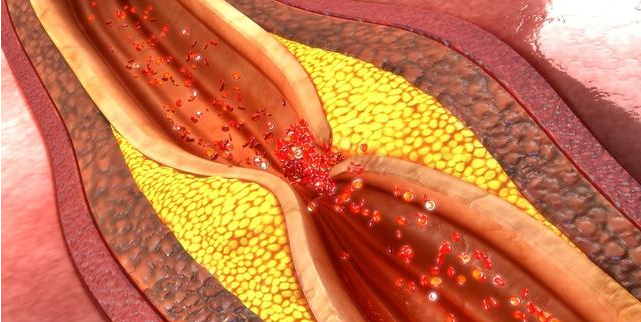 怎么判断血管是否堵塞 血管堵塞有什么症状