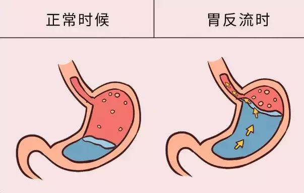 饭后返食物是怎么回事 饭后返食这是为什么2020