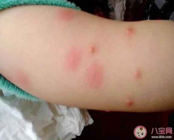 孩子过敏起疙瘩怎么办 孩子春季过敏起疙瘩是荨麻疹吗
