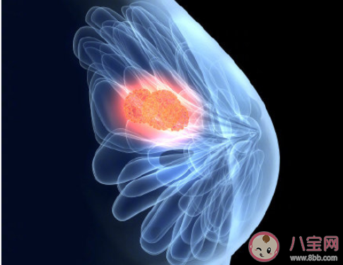 怎么远离乳腺癌 乳腺癌筛查几岁做