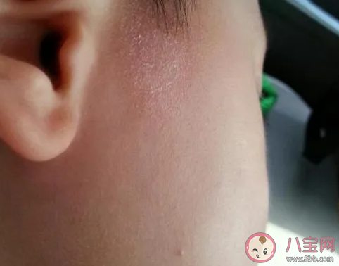 宝宝的脸上有一团团白色的东西是什么 儿童白色糠疹怎么治疗最有效