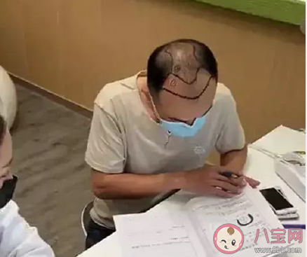 如何看待年轻人秃头问题 哪些习惯会导致秃头