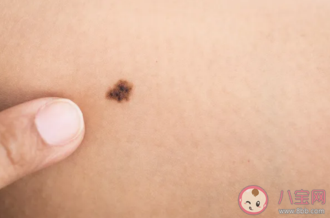 点完痣后当天可以敷面膜吗 点痣后什么时候可以擦护肤品
