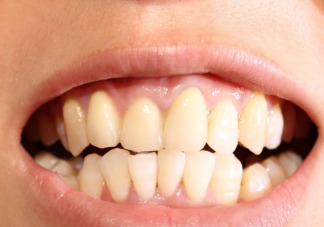 牙缝清洁真的有必要吗 牙缝清洁不到位有什么危害