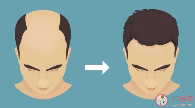 植发成男青年最热衷医美项目是真的吗 男生植发和女生植发有什么区别