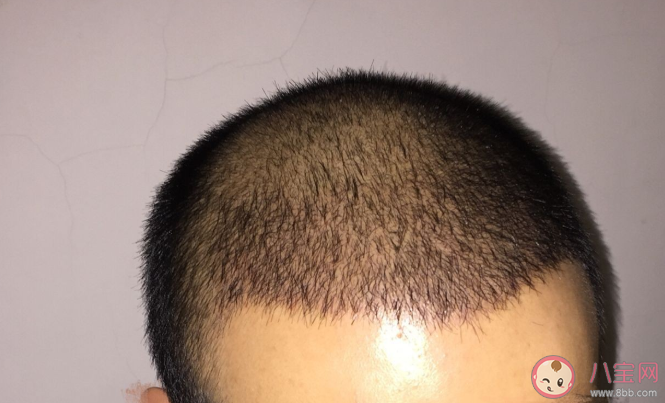 植发成男青年最热衷医美项目是真的吗 男生植发和女生植发有什么区别