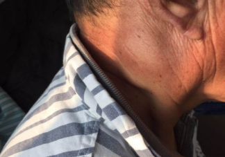 耳朵后面长了个包一按就疼怎么回事 耳朵后面长包怎么办