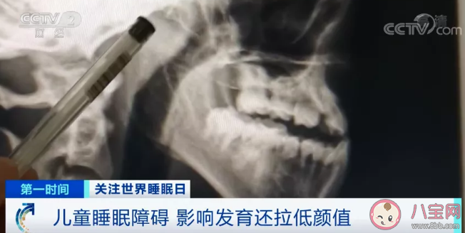 儿童睡不好会拉低颜值变丑吗 为什么对颜值有影响