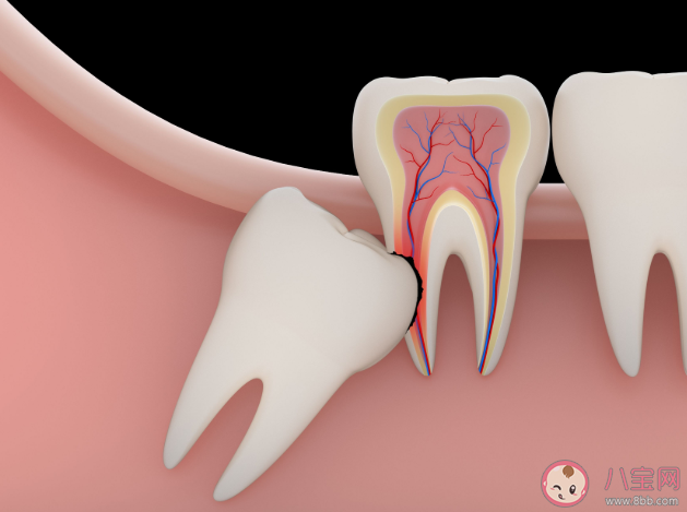 智齿每个人都会长吗 智齿不痛要拔吗 智齿每个人都会长吗 智齿不痛要拔吗