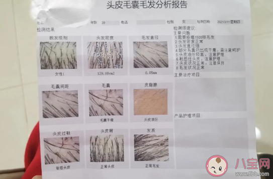 新华社暗访植发市场乱象 植发市场有哪些套路