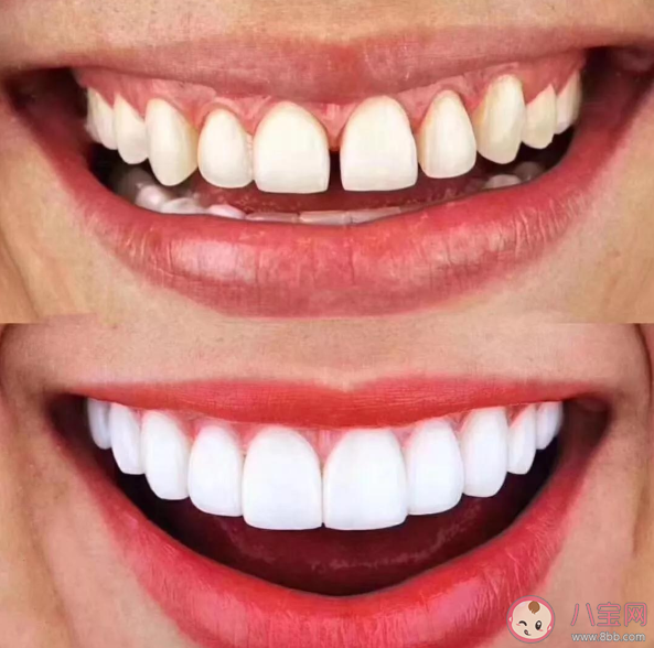 牙贴面美白牙齿好吗 牙齿贴面能维持多长时间