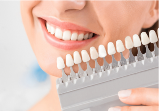 牙贴面美白牙齿好吗 牙齿贴面能维持多长时间