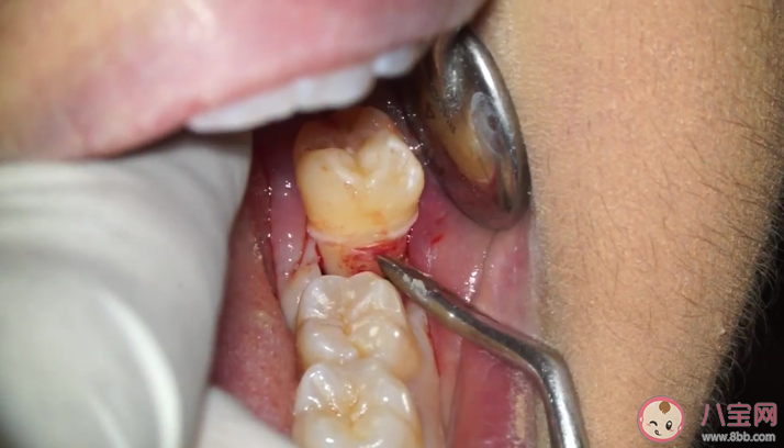 拔智齿有最佳年龄吗 拔智齿后要注意哪些事 拔智齿有最佳年龄吗 拔智齿后要注意哪些事