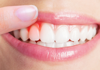 每天认真刷牙为什么会长牙结石 怎么去除牙结石