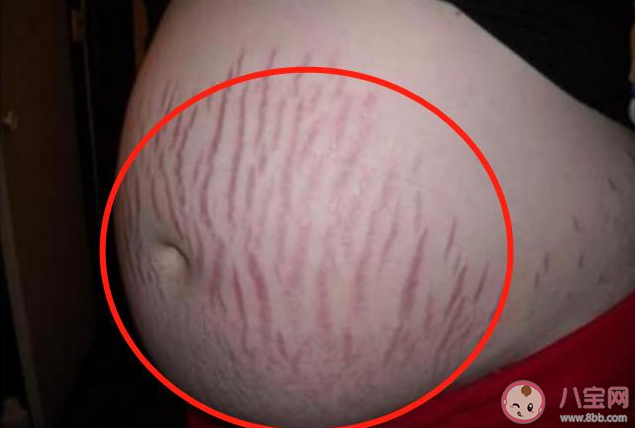 橄榄油能减淡已形成的妊娠纹吗 出现妊娠纹还能补救吗