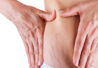 橄榄油能减淡已形成的妊娠纹吗 出现妊娠纹还能补救吗