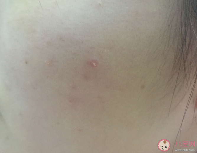 日常哪些原因会加重闭口 关于闭口的干货知识