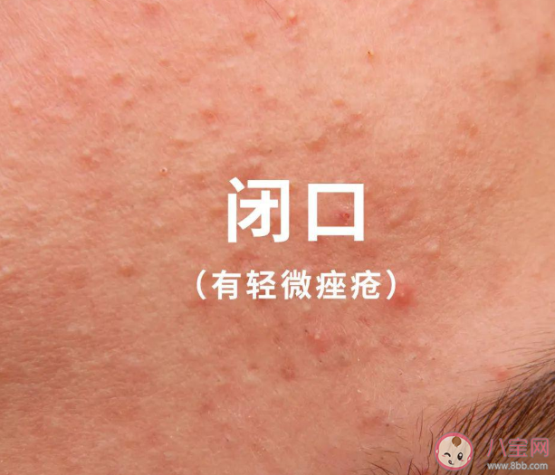 日常哪些原因会加重闭口 关于闭口的干货知识