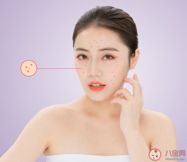 日常哪些原因会加重闭口 关于闭口的干货知识