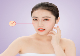 日常哪些原因会加重闭口 关于闭口的干货知识