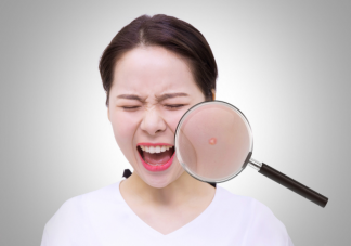 夏天为什么容易长痘 夏天如何预防长痘痘