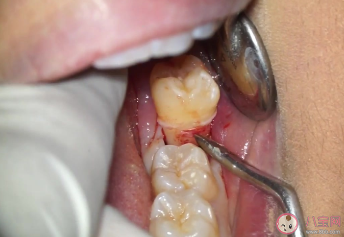 拔智齿收费价格为什么相差很大 拔智齿多长时间能恢复