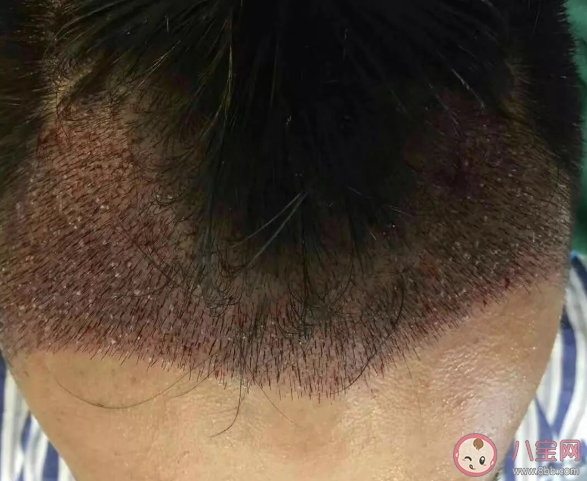 植发手术疼吗 植发手术第几天可以洗头