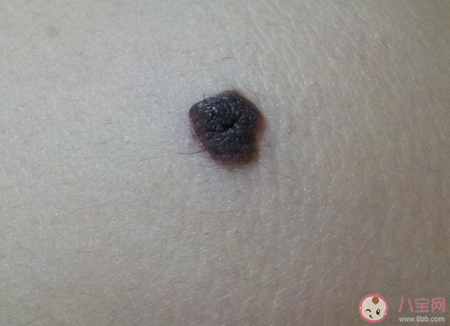 身体哪些部位上的痣一定要切除 怎么去除有问题的痣