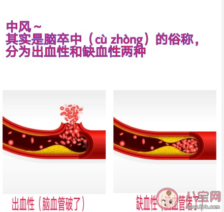 2021是第几个世界预防中风日 9种情况可能是中风先兆 2021是第几个世界预防中风日 9种情况可能是中风先兆