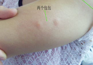 哪3类人最吸引蚊子 被蚊子叮咬后怎么止痒防感染