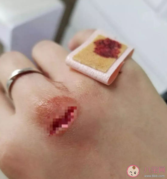 手受伤可以用口水舔一舔吗 受伤用嘴吸有什么后果