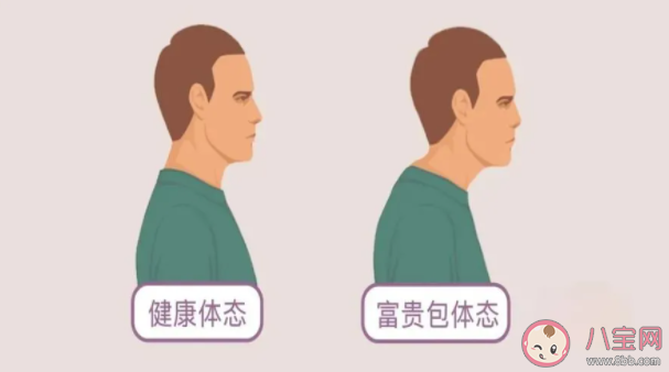 颈部长富贵包怎么改善 做什么动作能改善富贵包