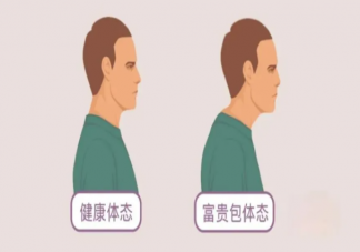 颈部长富贵包怎么改善 做什么动作能改善富贵包