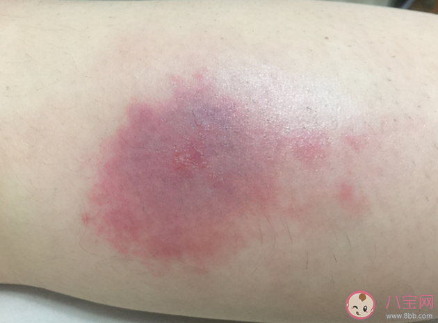 蚊子叮在身体的哪个部位最痒 如何快速止痒消肿不留疤