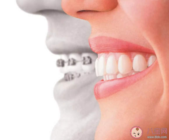 隐形矫正VS托槽矫正哪个好 第一次矫正牙齿要注意什么