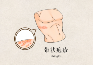 带状疱疹水泡可以戳破吗 带状疱疹有多折磨人