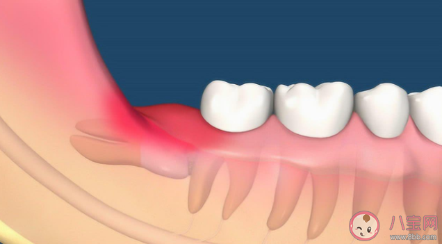 智齿没疼过也要拔吗 为什么智齿那么疼 智齿没疼过也要拔吗 为什么智齿那么疼