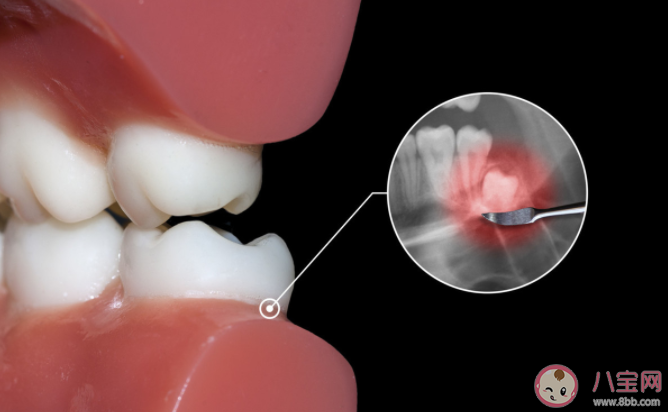 智齿没疼过也要拔吗 为什么智齿那么疼 智齿没疼过也要拔吗 为什么智齿那么疼