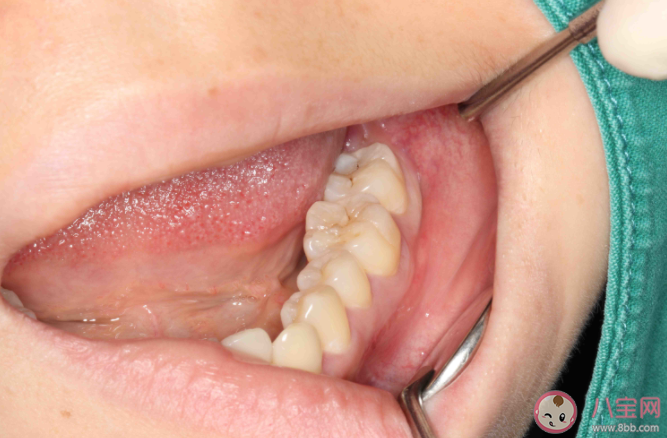 智齿没疼过也要拔吗 为什么智齿那么疼 智齿没疼过也要拔吗 为什么智齿那么疼