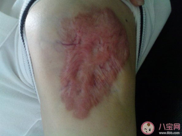 疤痕为什么会变成癌 什么疤痕容易变成癌 疤痕为什么会变成癌 什么疤痕容易变成癌