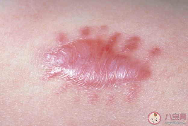 疤痕为什么会变成癌 什么疤痕容易变成癌 疤痕为什么会变成癌 什么疤痕容易变成癌