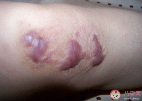 哪些症状可能是疤痕癌变 如何预防疤痕癌变