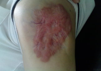 疤痕为什么会变成癌 什么疤痕容易变成癌