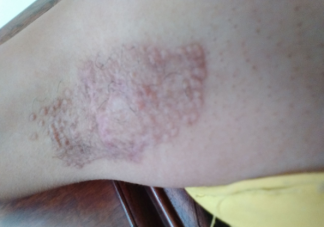 哪些症状可能是疤痕癌变 如何预防疤痕癌变