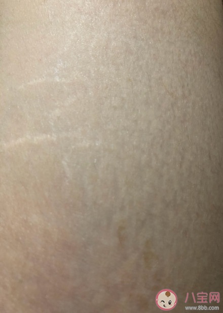 肥胖纹会自己好吗 肥胖纹是因为长得太胖了吗 肥胖纹会自己好吗 肥胖纹是因为长得太胖了吗