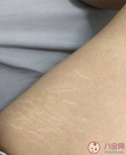 肥胖纹会自己好吗 肥胖纹是因为长得太胖了吗 肥胖纹会自己好吗 肥胖纹是因为长得太胖了吗