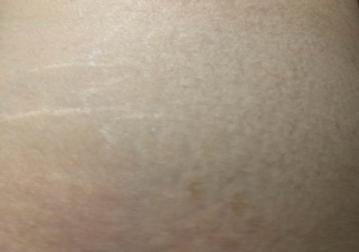 肥胖纹会自己好吗 肥胖纹是因为长得太胖了吗